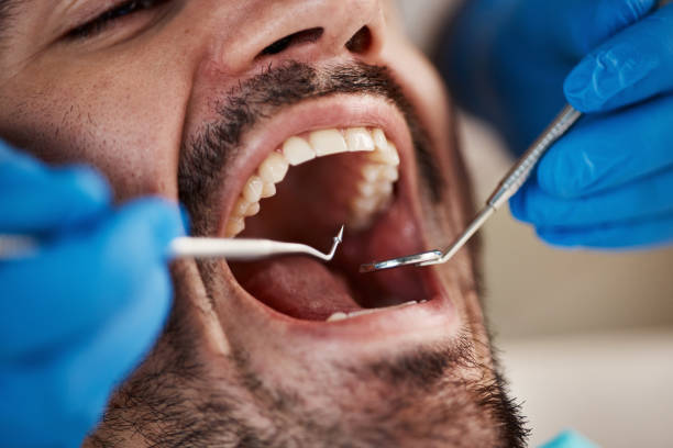 Best Knocked-Out Tooth (Avulsed Tooth) Treatment in Duncanville, TX